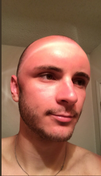 Once I came up with the idea to shave my head, after which I was safely burned in the sun and the upper part of my head was a little swollen :) - Bald head, Humor, Burned, Tumor, The photo, Red, Longpost