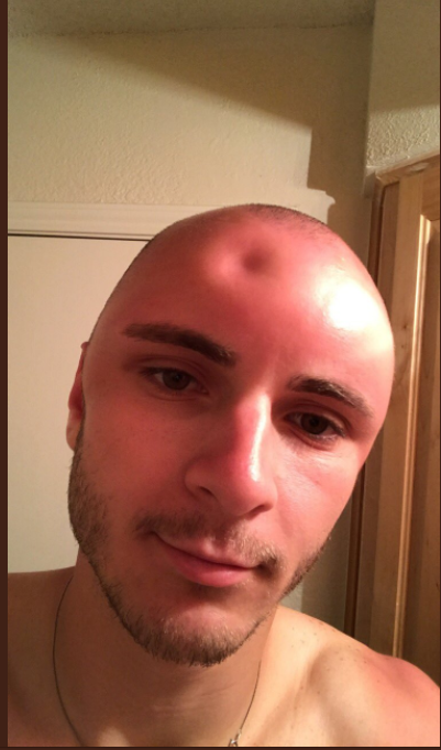 Once I came up with the idea to shave my head, after which I was safely burned in the sun and the upper part of my head was a little swollen :) - Bald head, Humor, Burned, Tumor, The photo, Red, Longpost