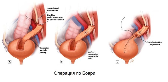 Ãèäðîíåôðîç Ìåäèöèíà, Óðîëîãèÿ, Ãèäðîíåôðîç, Äëèííîïîñò