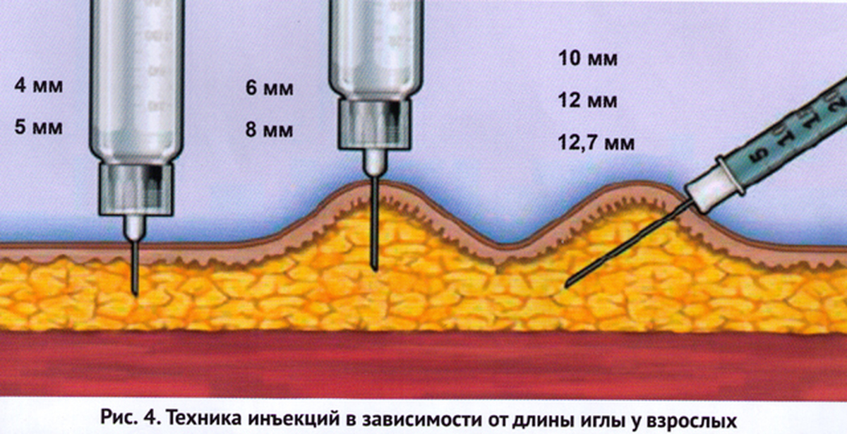 Введении в кожу инъекций. Введение инсулина шприцом подкожно. Иглы для инъекции липолитиков. Введение инсулина шприц ручкой. Угол введения иглы инсулина.