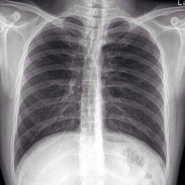 Where is it? - X-ray, Heart, Longpost