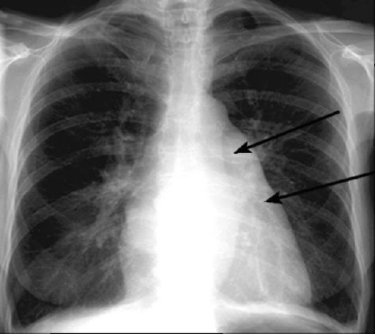 Where is it? - X-ray, Heart, Longpost