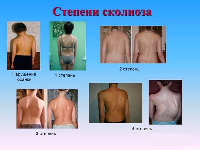 The 4th degree looks like a KAMAZ crashed into your side, but you didn’t fall, but steadfastly withstood the blow! - Kamaz, Scoliosis, Persistence, Fine