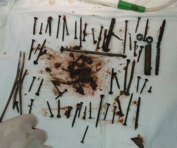 150 nails, screws, nuts and bolts were removed from the stomach of a resident of Buryatia - Buryatia, Nails, Operation, Long-post, Longpost