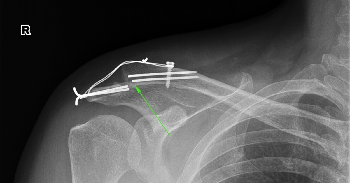 Операция ключица спицами. Вывих акромиального конца рентген. Акромиальный перелом ключицы рентген. Внутрикостный остеосинтез ключицы. Акромиального конца ключицы рентген.