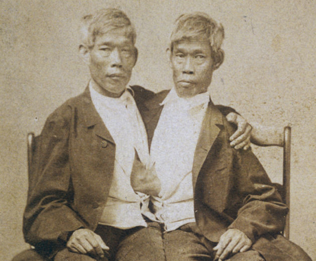 Сиамские близнецы истории и фото