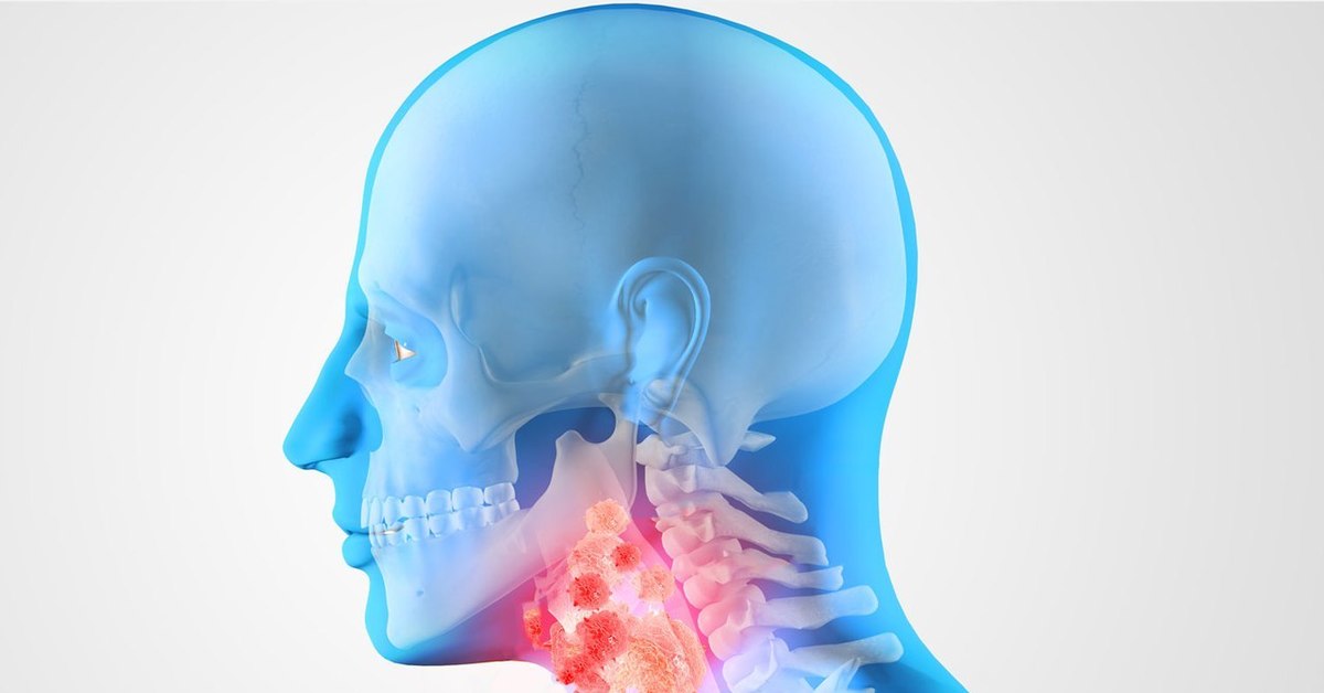 Рак Горла Стадии Фото