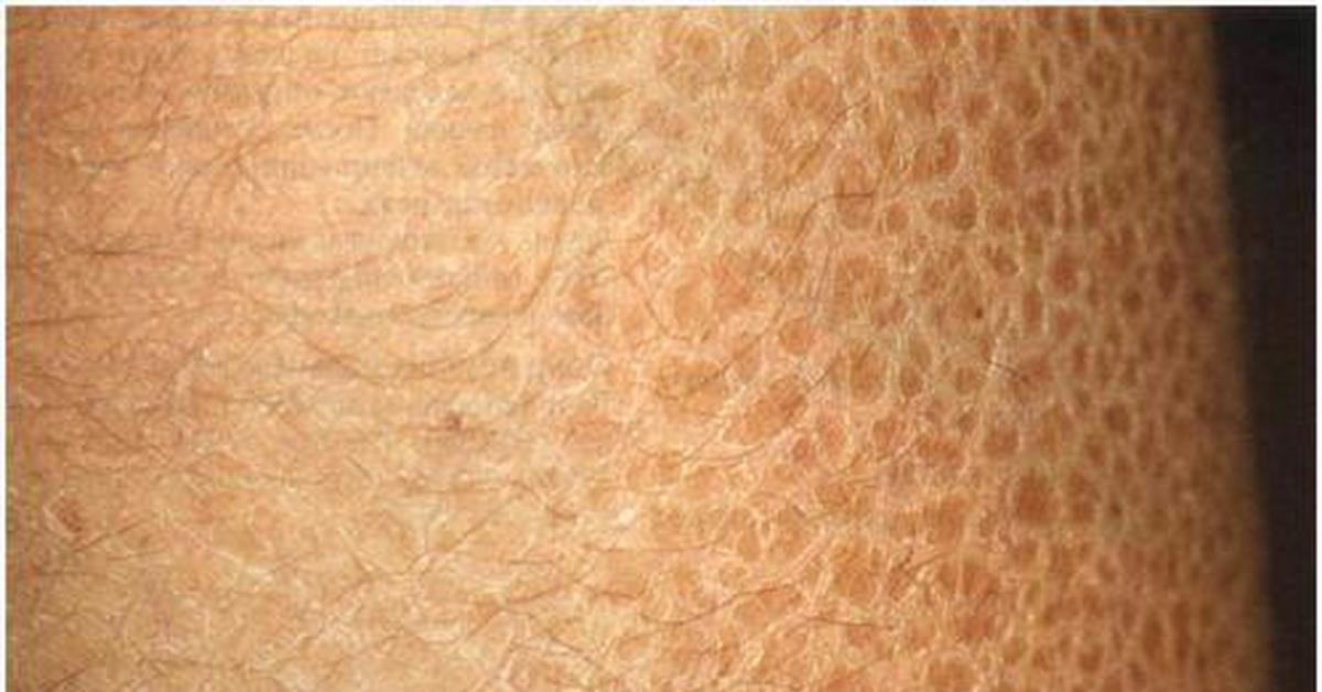 Ксероз кожи. Отшелушивание кожи на теле. Выраженный ксероз кожи. Ксероз кожи физический.