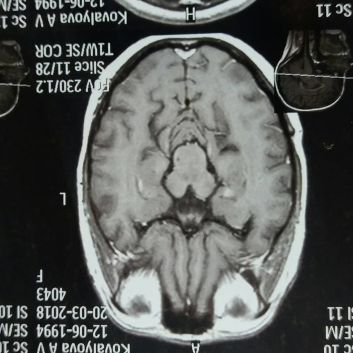 Need advice, neurooncologist - My, , Astrocytoma, Oncology, MRI, Brain cancer, , Crayfish, , Longpost