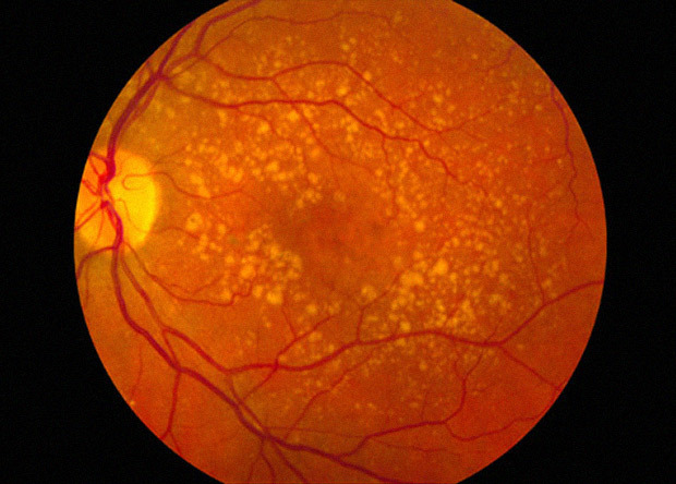 Implantation of the pigment layer of the retina did not allow patients to go blind - The science, news, The medicine, Retina, Vision