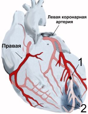 Myocardial infarction - how not to die young - My, Longpost, Heart attack, The medicine, Health, A life, Knowledge, Disease