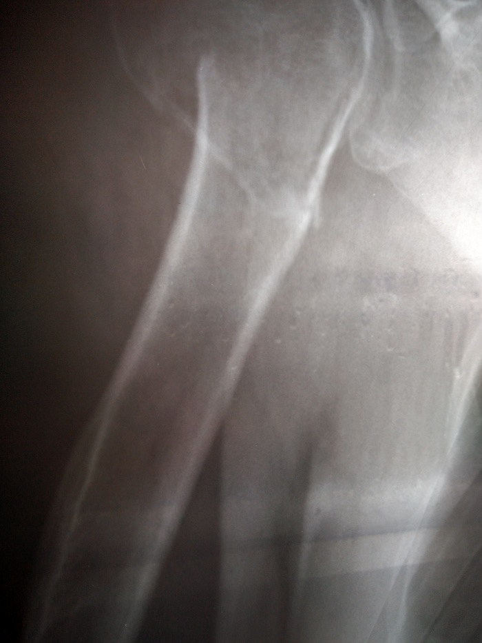 Problem after fracture of the humerus - My, Shoulders, Fracture, Health, Doctors need help, Contracture, My, Longpost