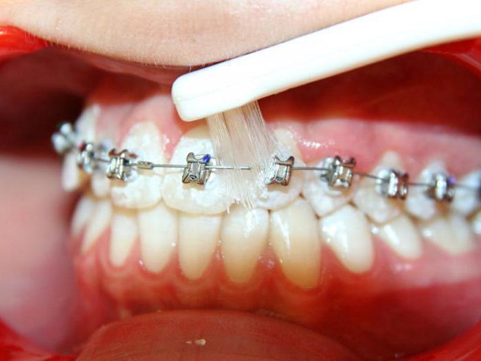 Braces .. why are they needed and what they are - Teeth, Braces, Video, Longpost