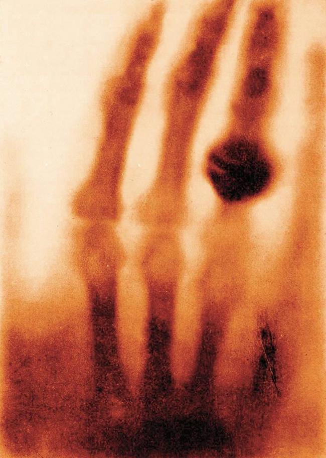 World's first x-ray (1895) - The photo, X-rays, First, X-ray