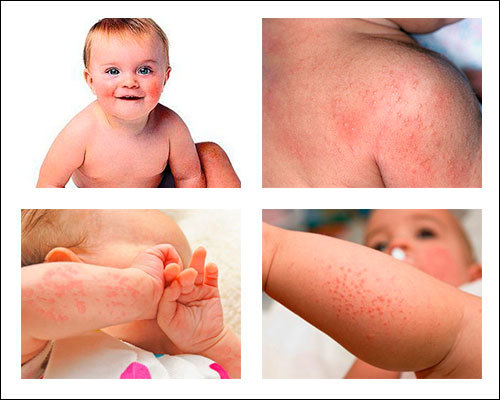 Urticaria in a child - My, Hives, Children, Rash, Symptoms, Leather, Allergen, Longpost