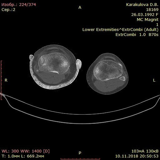 Fracture of the condyle / tibia - Broken leg, Injury, Saint Petersburg, Need advice, Longpost