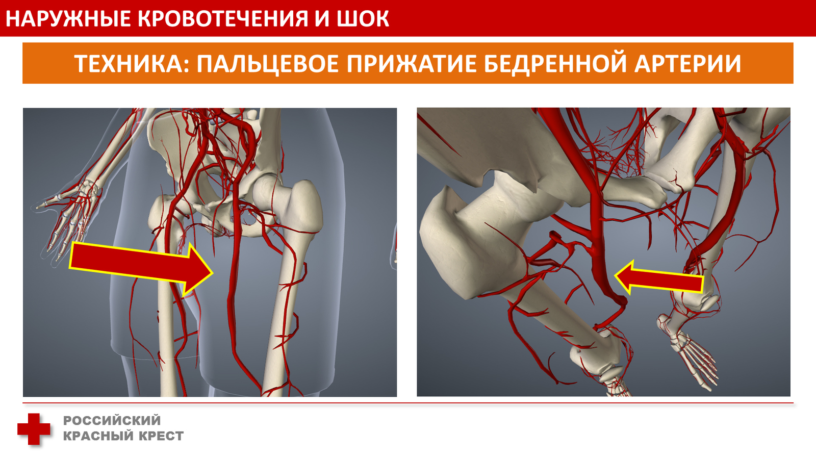 Тромбэктомия подключичной артерии. Ранение бедренной артерии. Наружные кровотечения бедренной артерии. Тромбоз подключичной артерии. По дну чего проложена артерия жизни