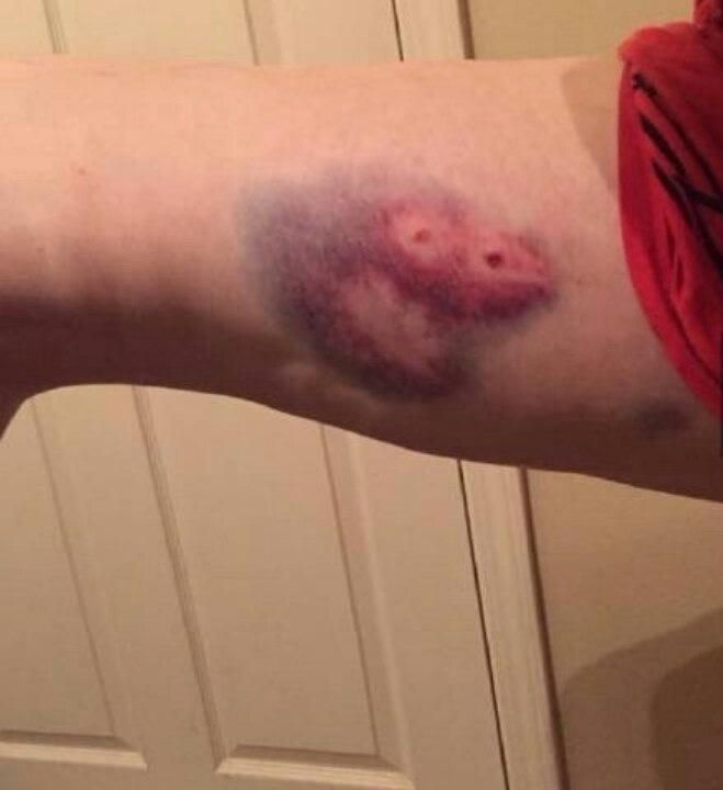 This bruise reminds me of someone - Bruise, , , Sadness, Pepe