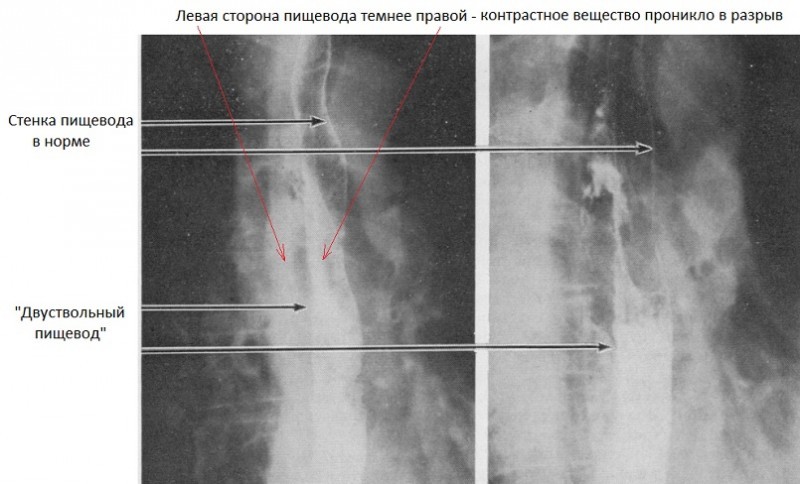 Чихание закрытым ртом убивает. Клинические случаи - Здоровье, Полезное, Длиннопост