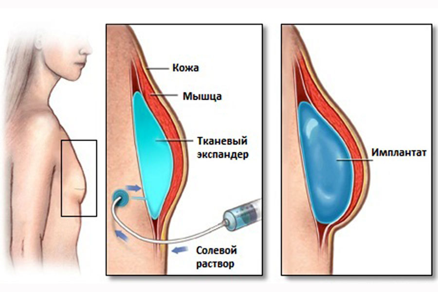 A little about mammoplasty 3. What implants are filled with - NSFW, My, Boobs, Strawberry, Longpost, Mammoplasty, Implants, My, Video