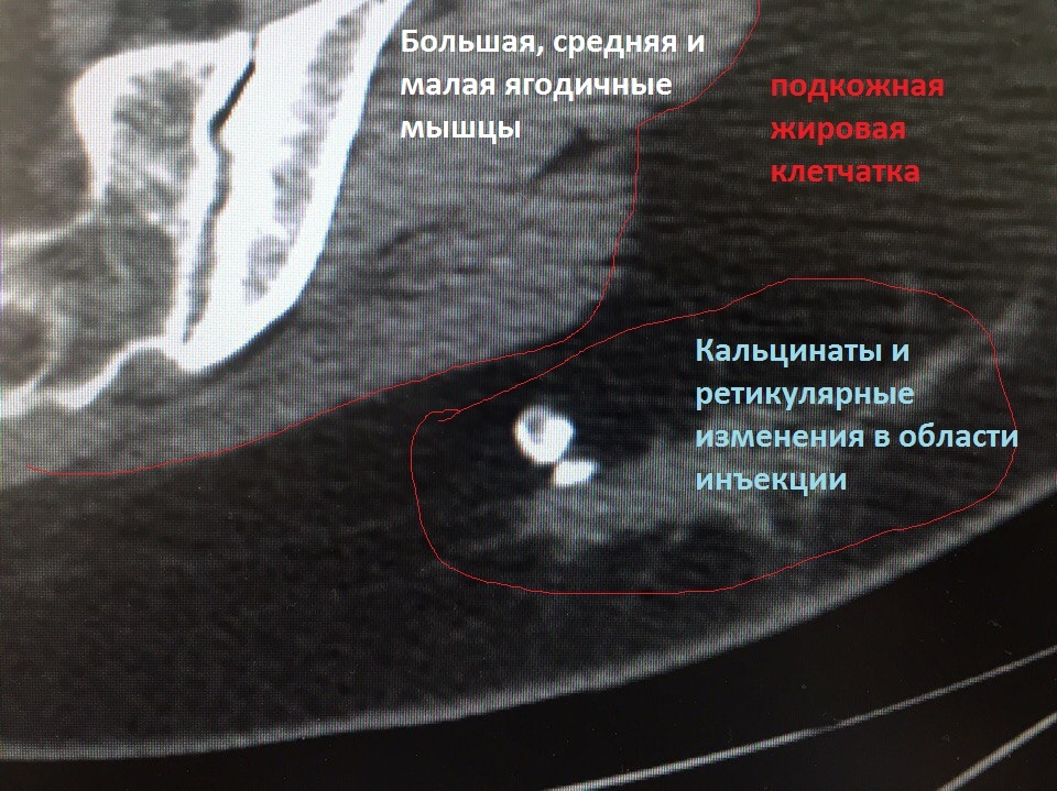 Почему лечение, не всегда помогает? - Моё, Укол, Кт, Толстые, Здоровье, Полнота