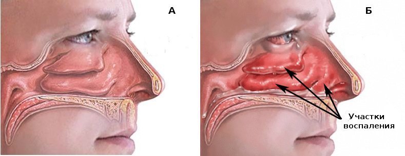 Me and my nose. A quarter of a century before happiness. - My, The medicine, Operation, Xylometazoline, Happiness, Text, My, Many letters, Longpost