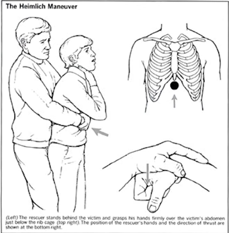 Heimlich maneuver - , Choked