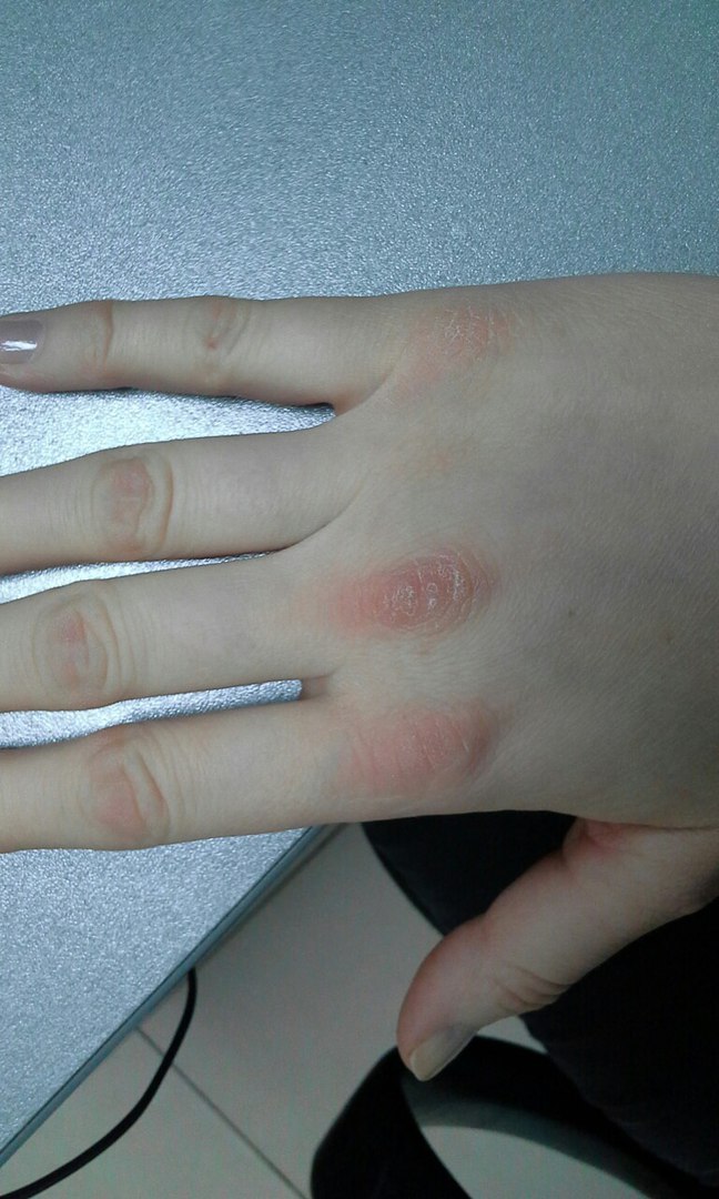 Boxer's fingers. - My, Health, Disease, The medicine, Dermatology, Longpost