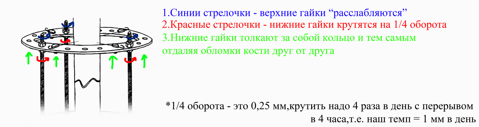 Аппарат Илизарова. Мой опыт - Моё, Аппарат илизарова, Опыт, Этапы, Совет, Больница, Длиннопост