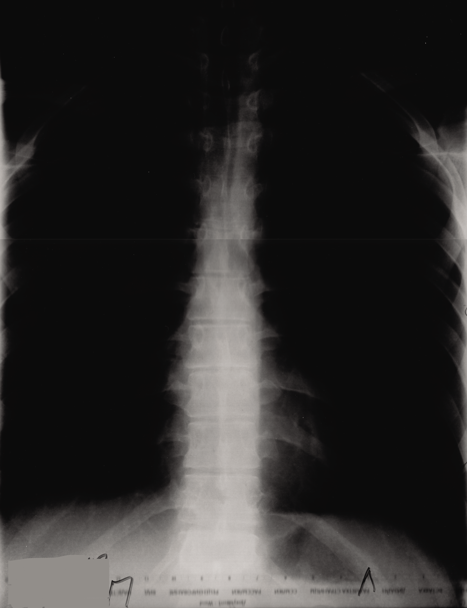 Displacement of 4 vertebrae - My, Displacement of the vertebrae, 