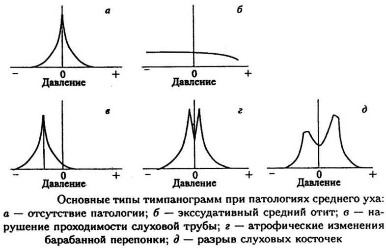 Проходимость слуховых труб 1 степень