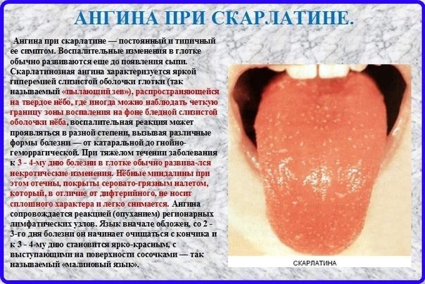 Ангина | Пикабу