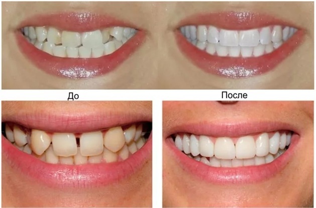 Affordable dentistry. Snow-white smile - My, Dentistry, Teeth, Smile, beauty, Health, My, Longpost