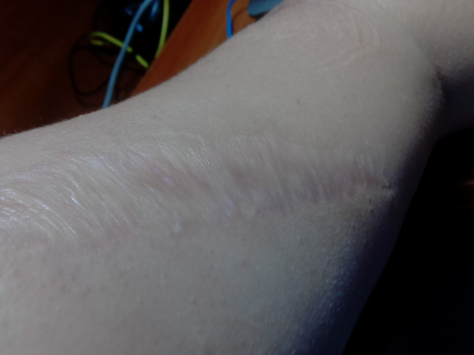 How I almost lost my arm. - Childhood, Scar