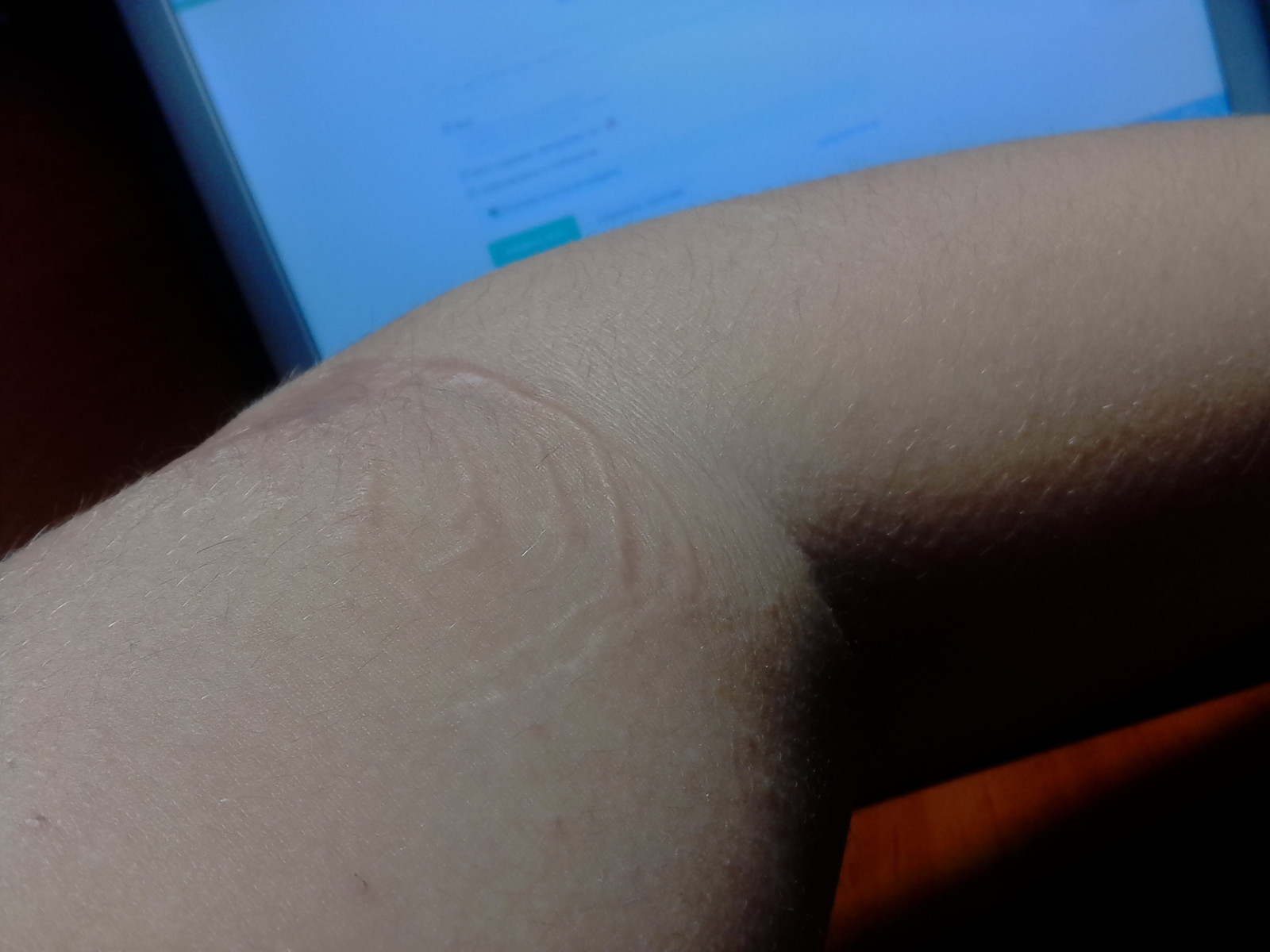 How I almost lost my arm. - Childhood, Scar