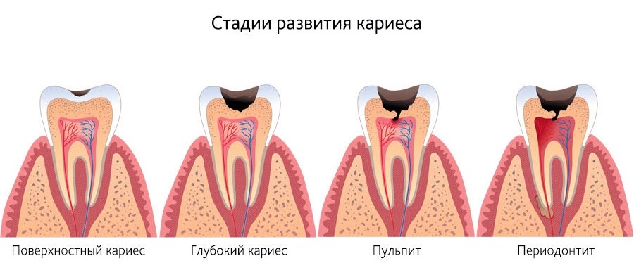 Simple Dentistry. Caries. - , Longpost, The medicine, Facts, Images, Dentistry, The science