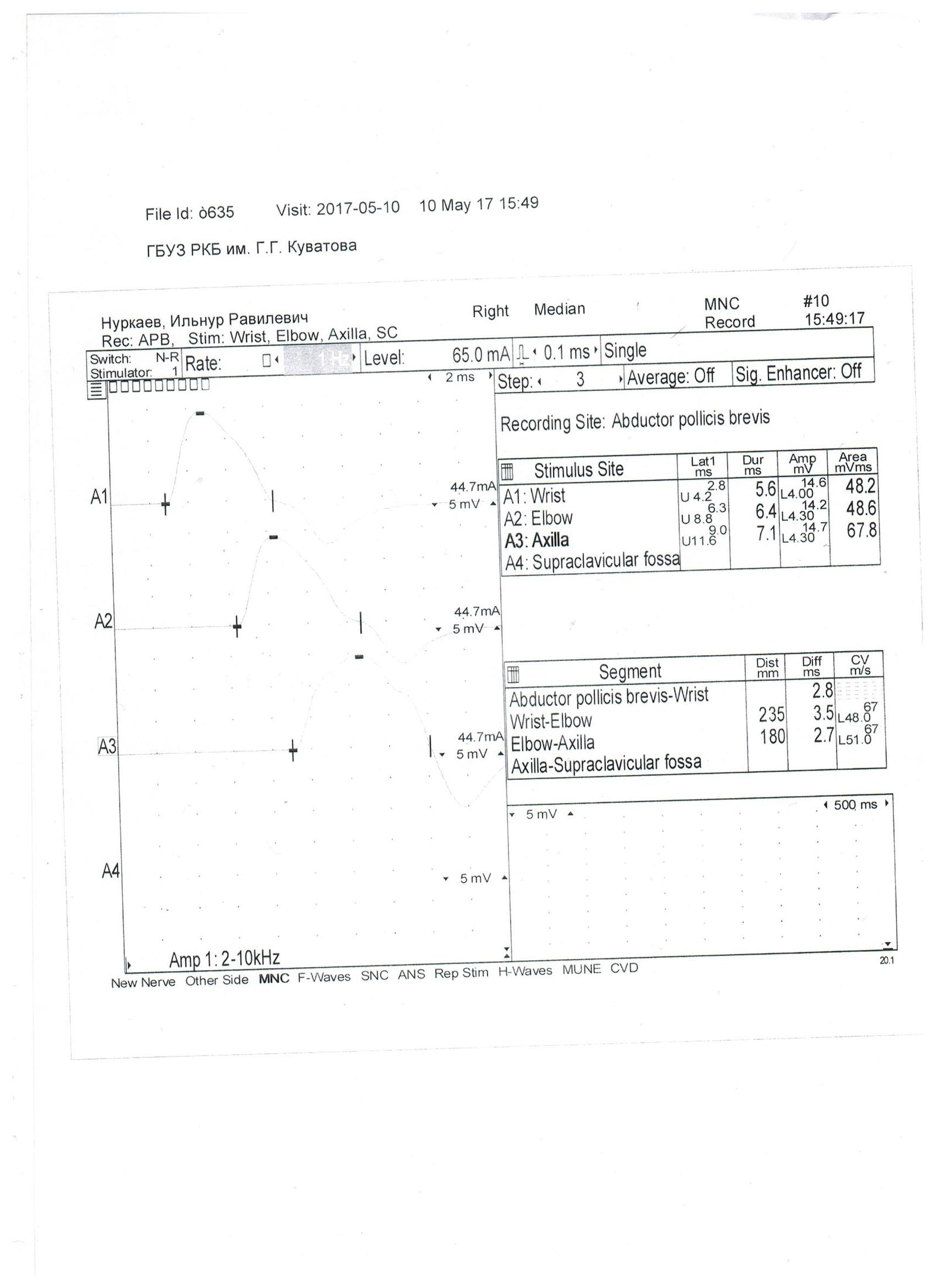 Undertook to study the direction of electroneuromyography and need help with decoding - My, , , Neurology, Neurosurgery, The medicine, Longpost