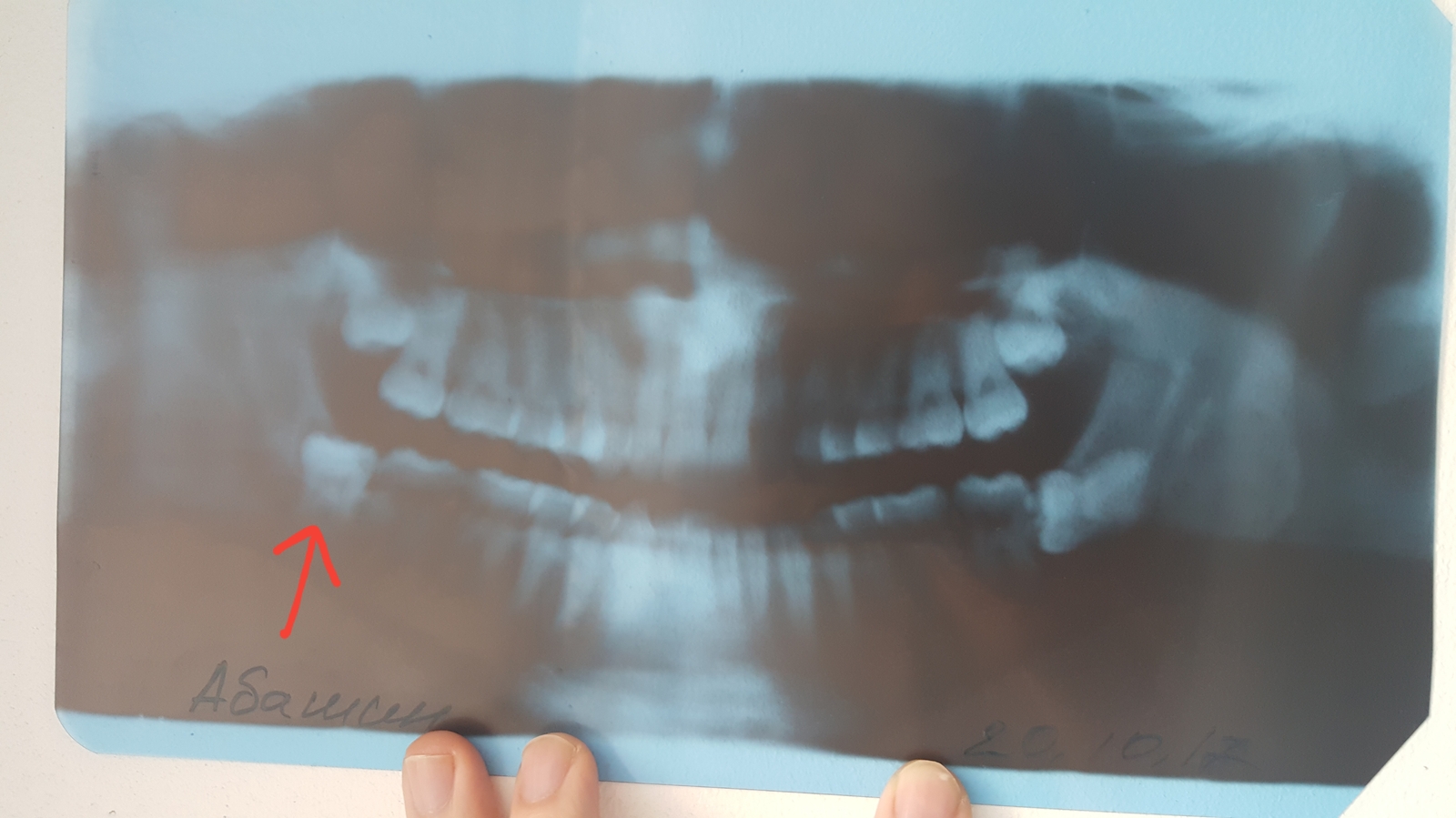 Removal of the lower eight, or wise evil has awakened. - My, Wisdom tooth, Dentistry