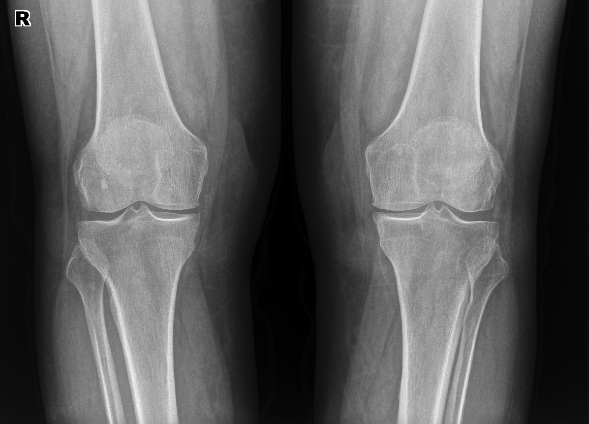 From the life of a radiologist. Part 5 - My, X-ray, The medicine, Fracture, Crack, Longpost