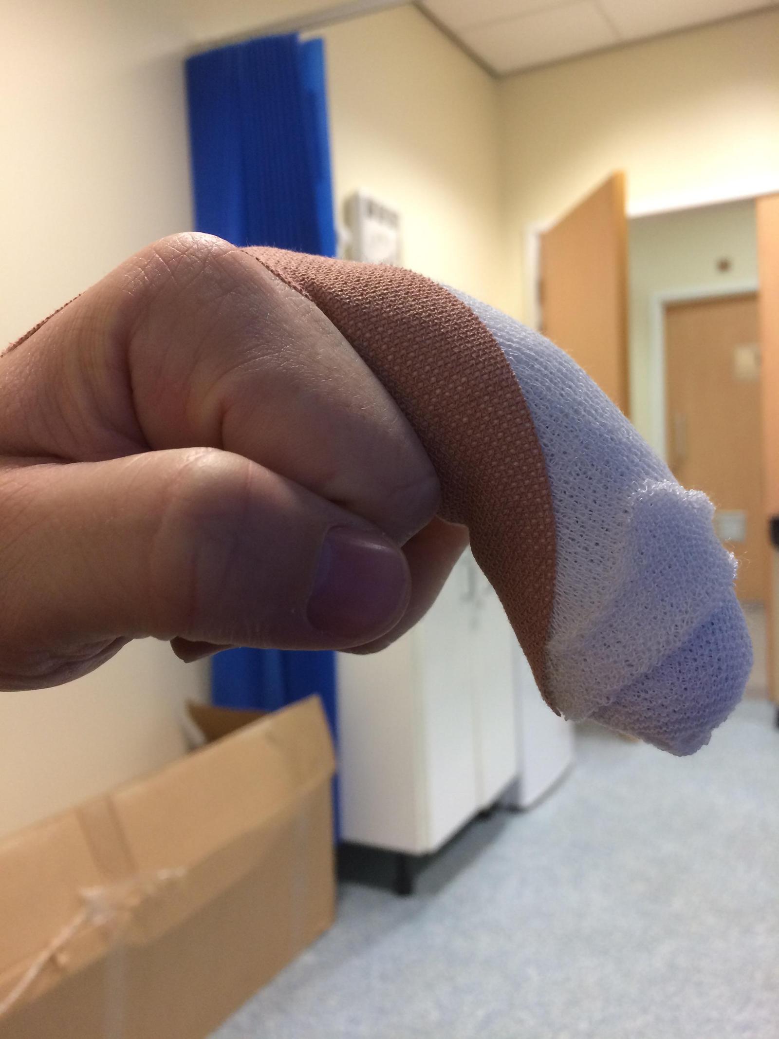 finger after surgery - Middle finger, Operation, Recovery