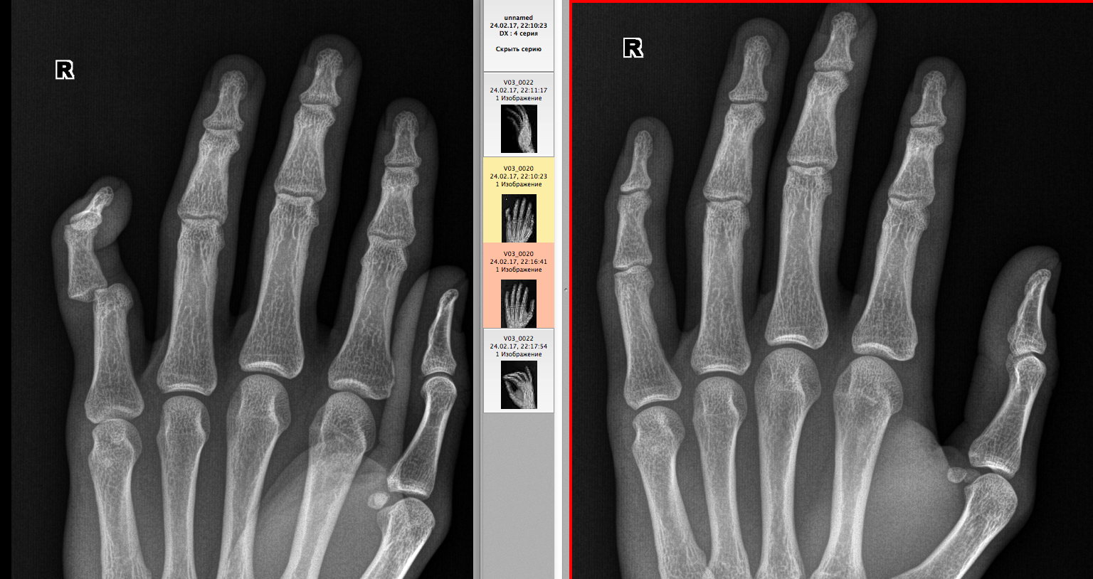 Трещина фаланги. Подвывих фаланги пальца руки рентген. Перелом фаланги пальца рентген. Остеоэпифизеолиз фаланги пальца. Кости кисти рентген вывих 1 пальца.
