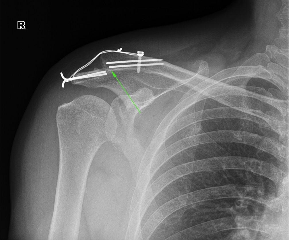 Разрыв ключицы фото