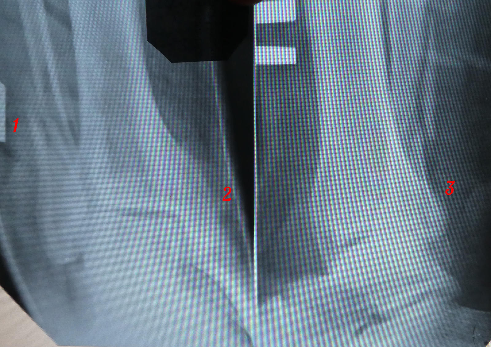 You need the help of a traumatologist, surgeon, or orthopedist. - My, Medics, Injury, Broken leg, The medicine, Longpost