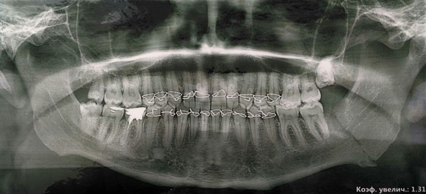 Fracture of the lower jaw. Myths and reality (photo) - Jaw, Fracture, Jaw fracture, Fracture of the lower jaw, , Splinting, , Longpost