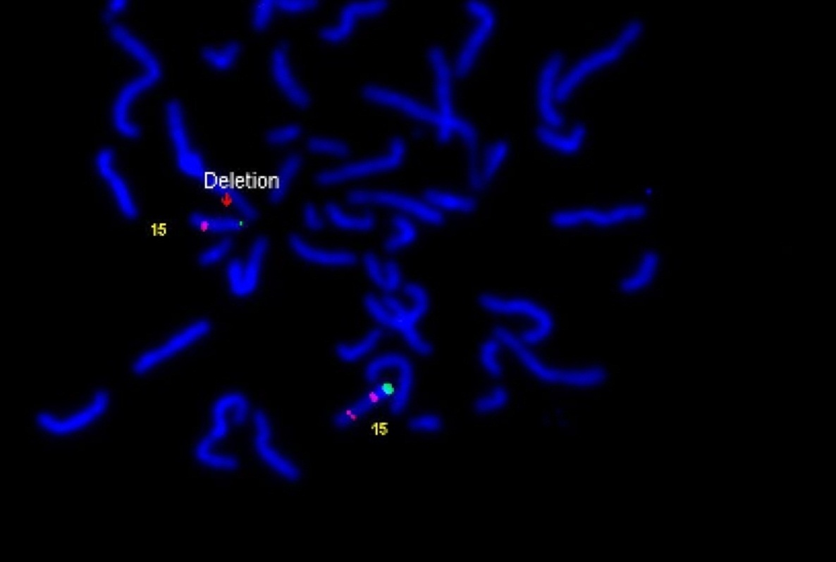 A little about the karyotype and why we do it. - My, Genetics, , Education, The science, Genome, , , Infertility, Longpost, Genetic diseases