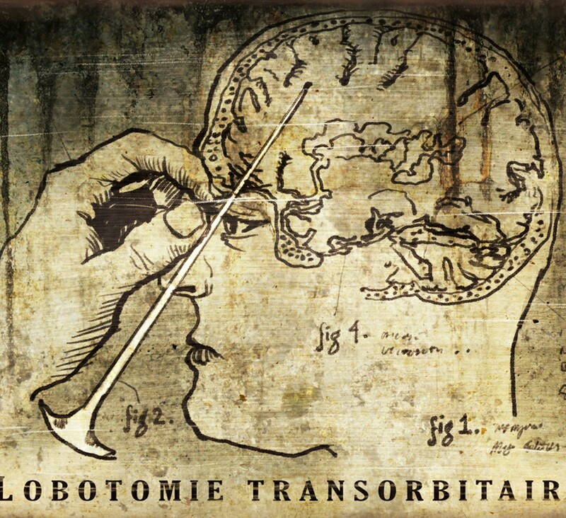 This amazing lobotomy - The medicine, Lobotomy, Facts, Longpost