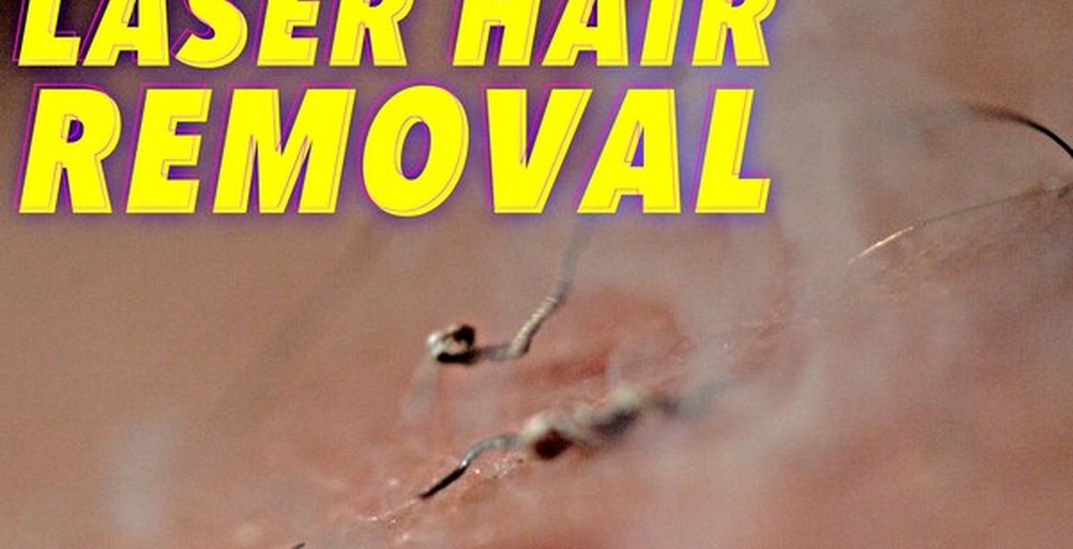 Лазерная эпиляция в слоу-мо | Пикабу