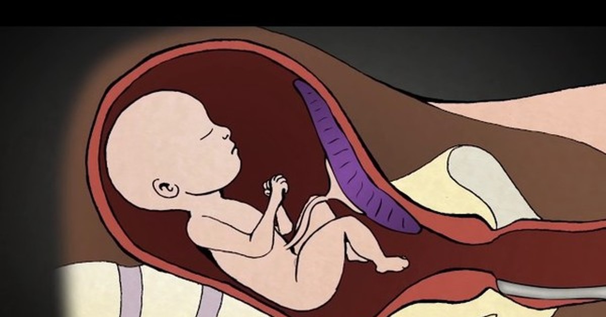 После прокола пузыря начинаются роды. Искусственные роды на большом сроке. Иллюстрации на тему аборта. Искусственное прерывание родов. Рисунки искусственного прерывания беременности.