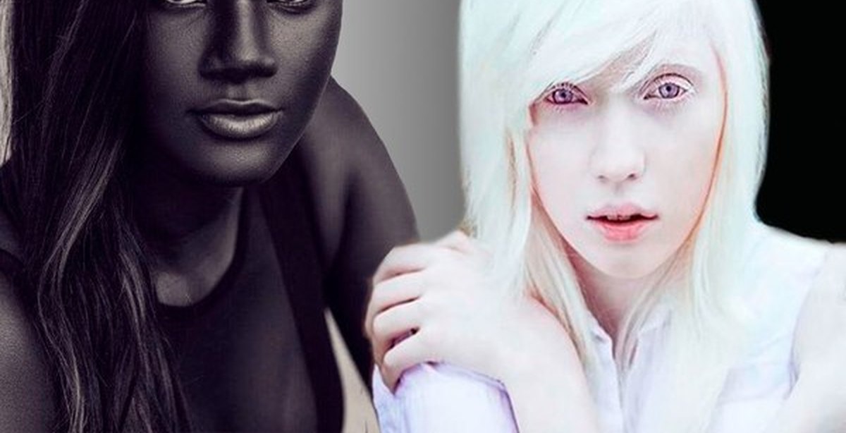 Чернокожая белокожая. Настя Жидкова альбинос. Девушка с черной кожей. Альбинос с темной кожей.